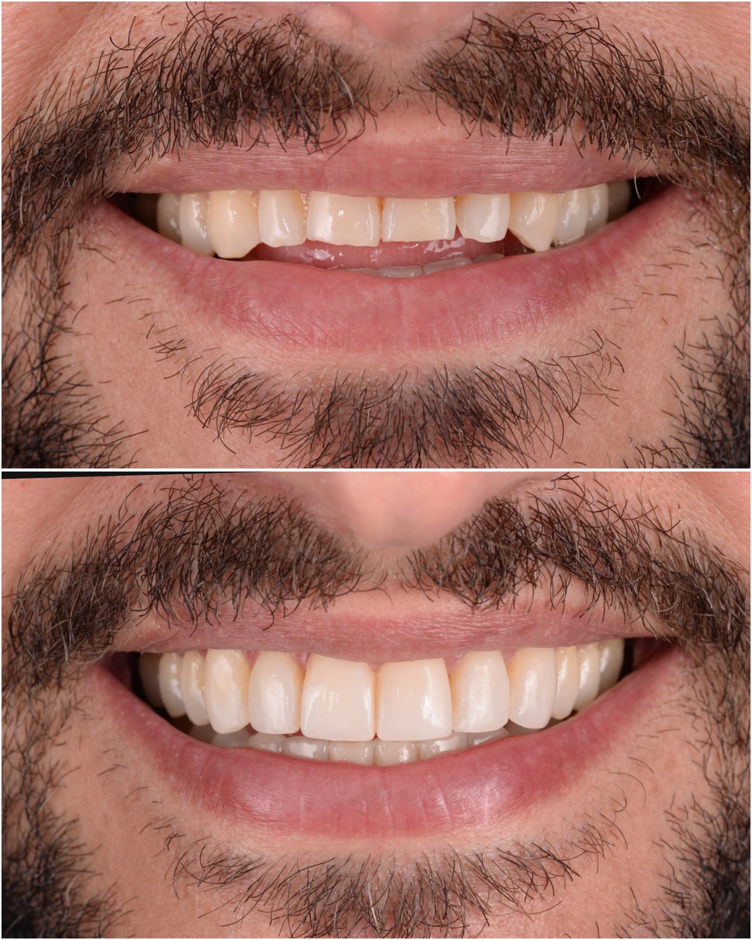Antes y después de una transformación de sonrisa