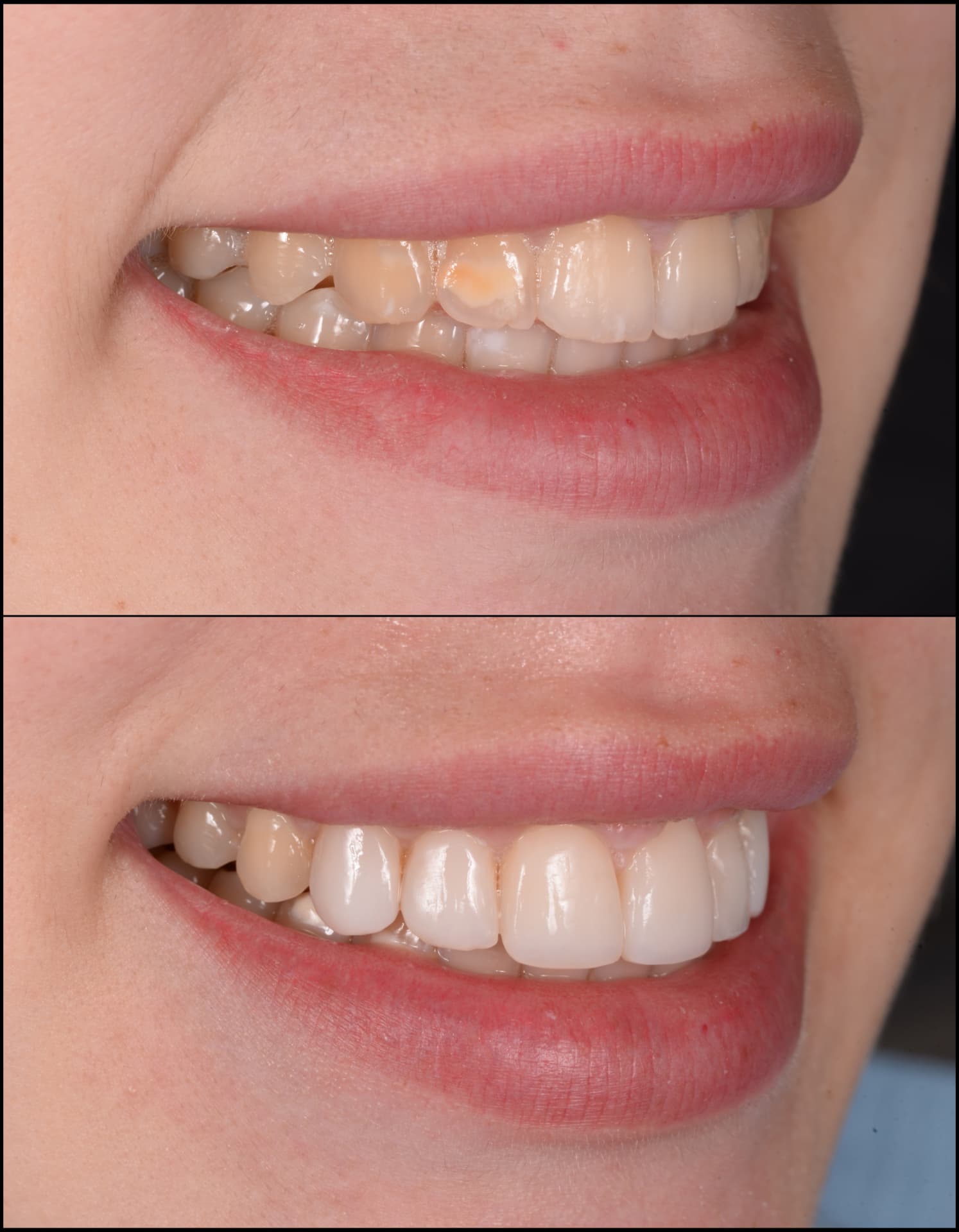 Antes y después de una transformación de sonrisa