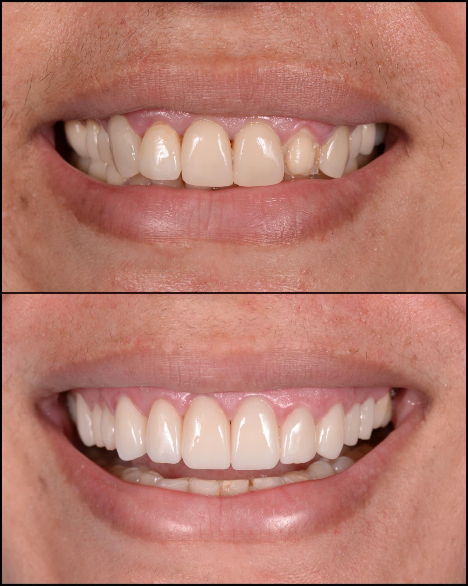 Antes y después de una transformación de sonrisa