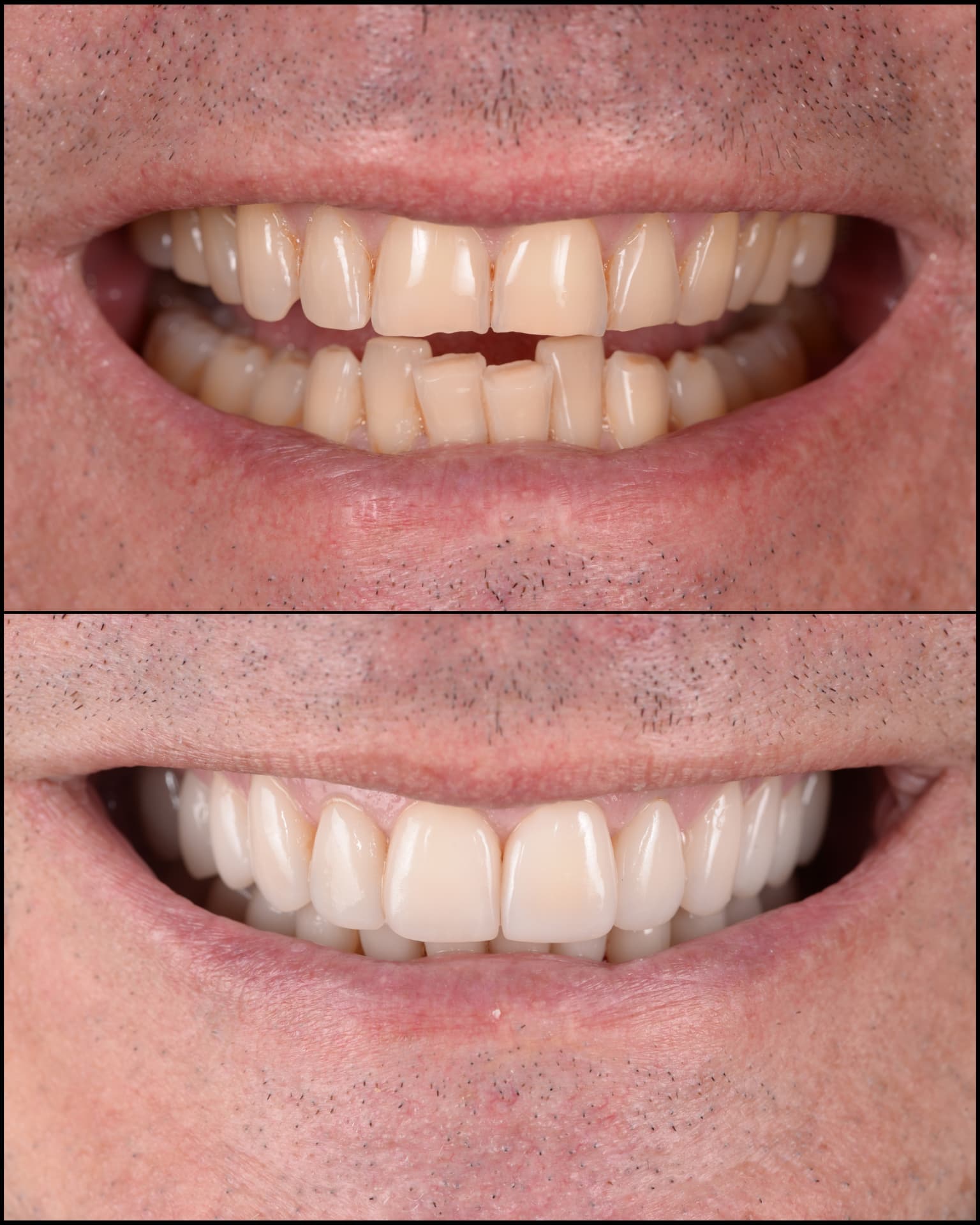 Antes y después de una transformación de sonrisa