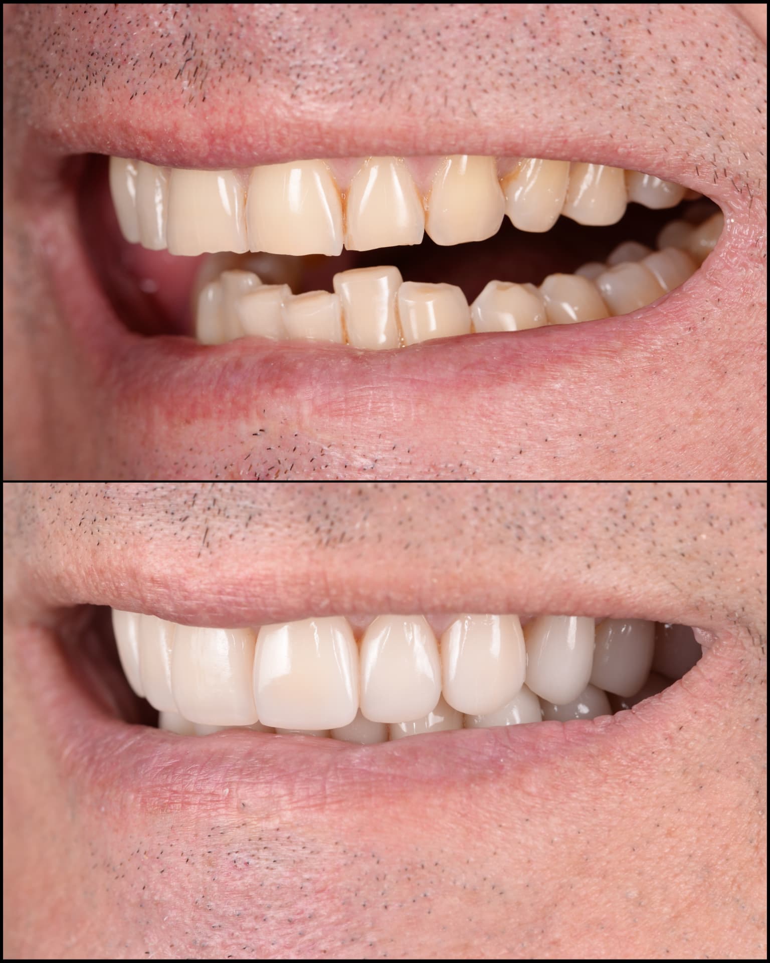 Antes y después de una transformación de sonrisa