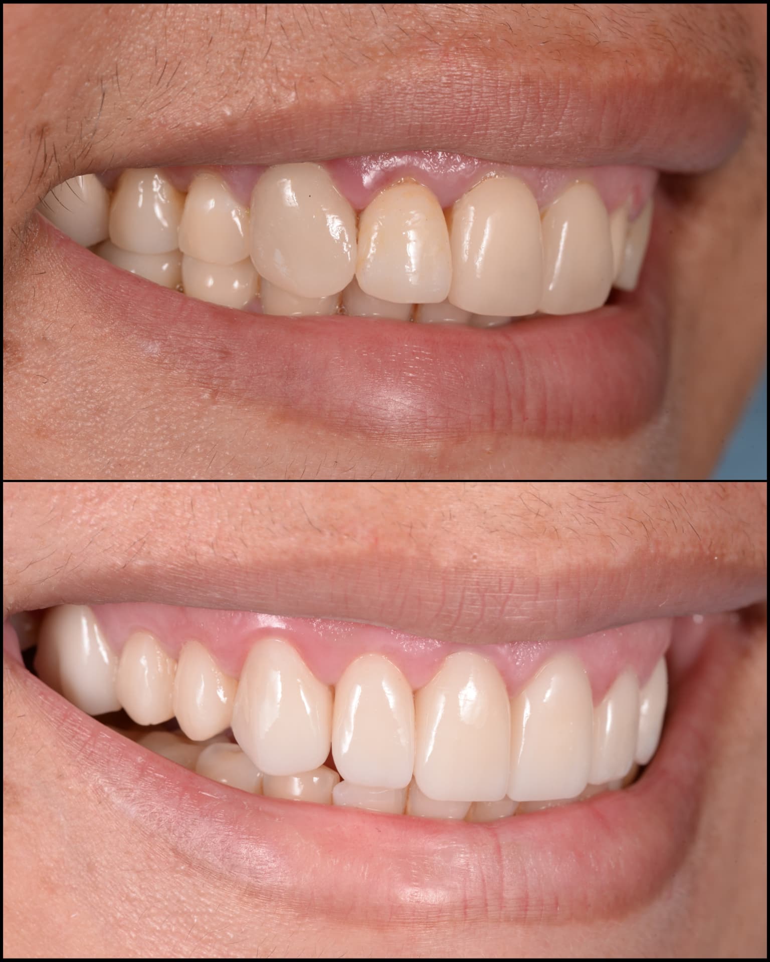 Antes y después de una transformación de sonrisa