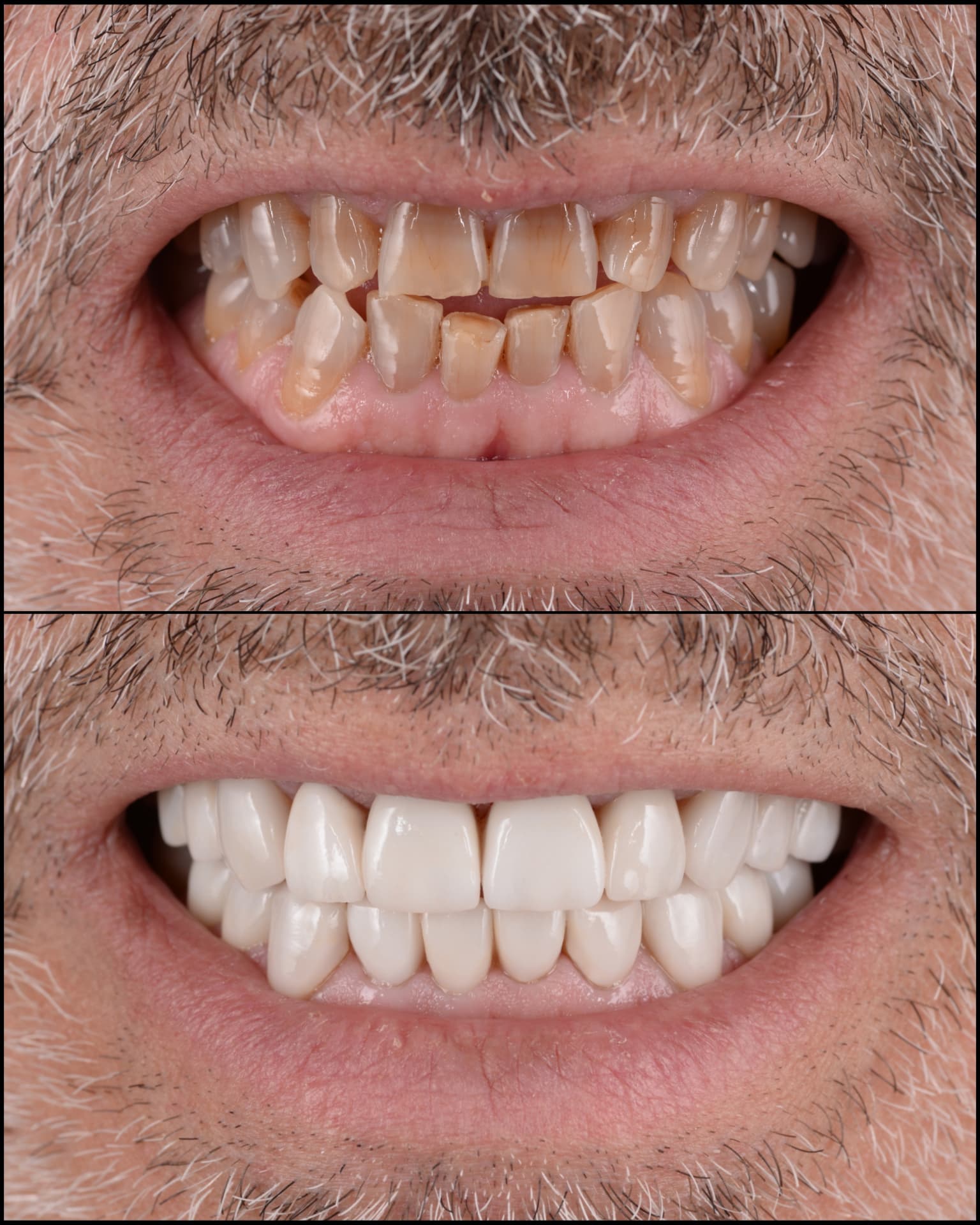 Antes y después de una transformación de sonrisa