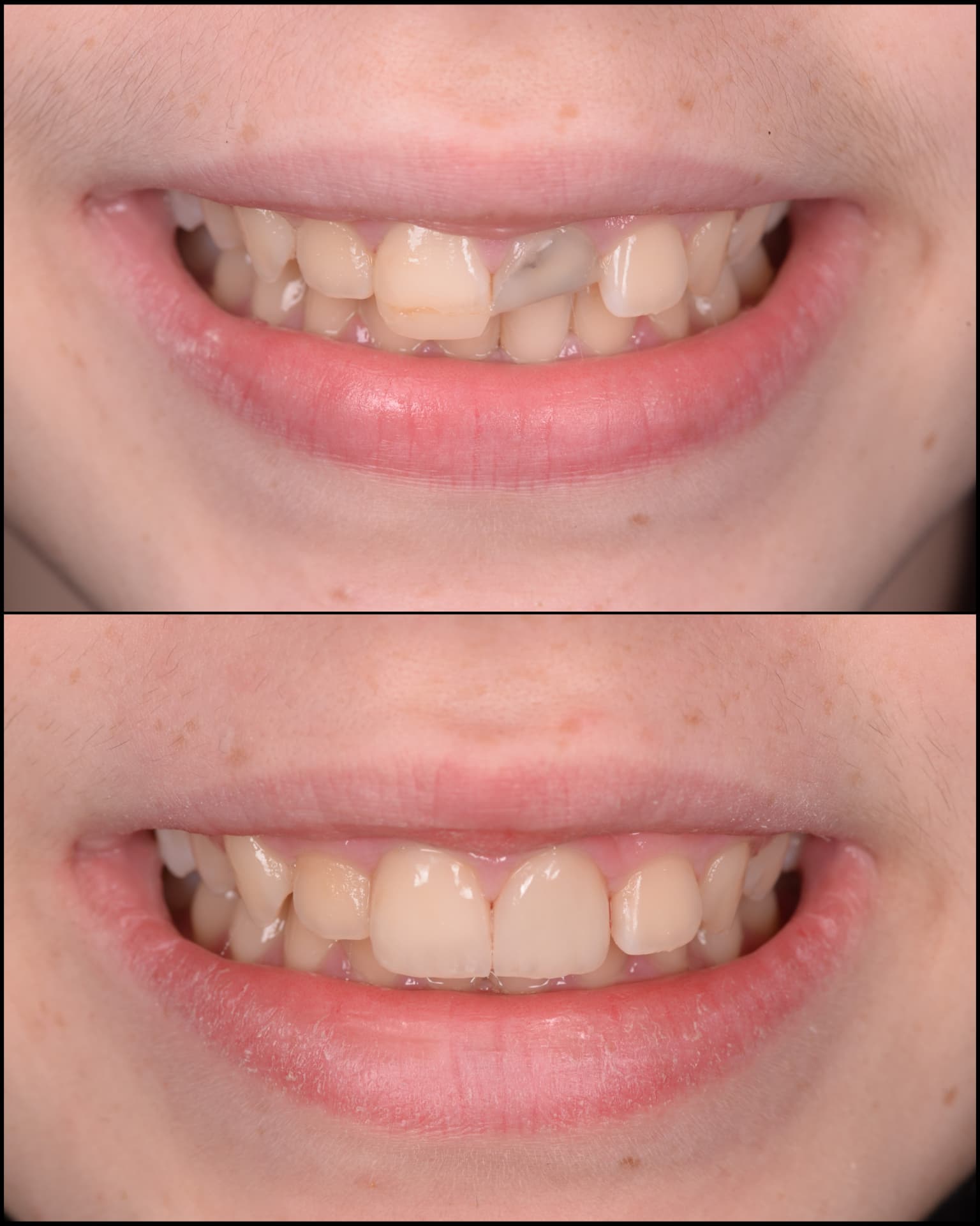 Antes y después de una transformación de sonrisa