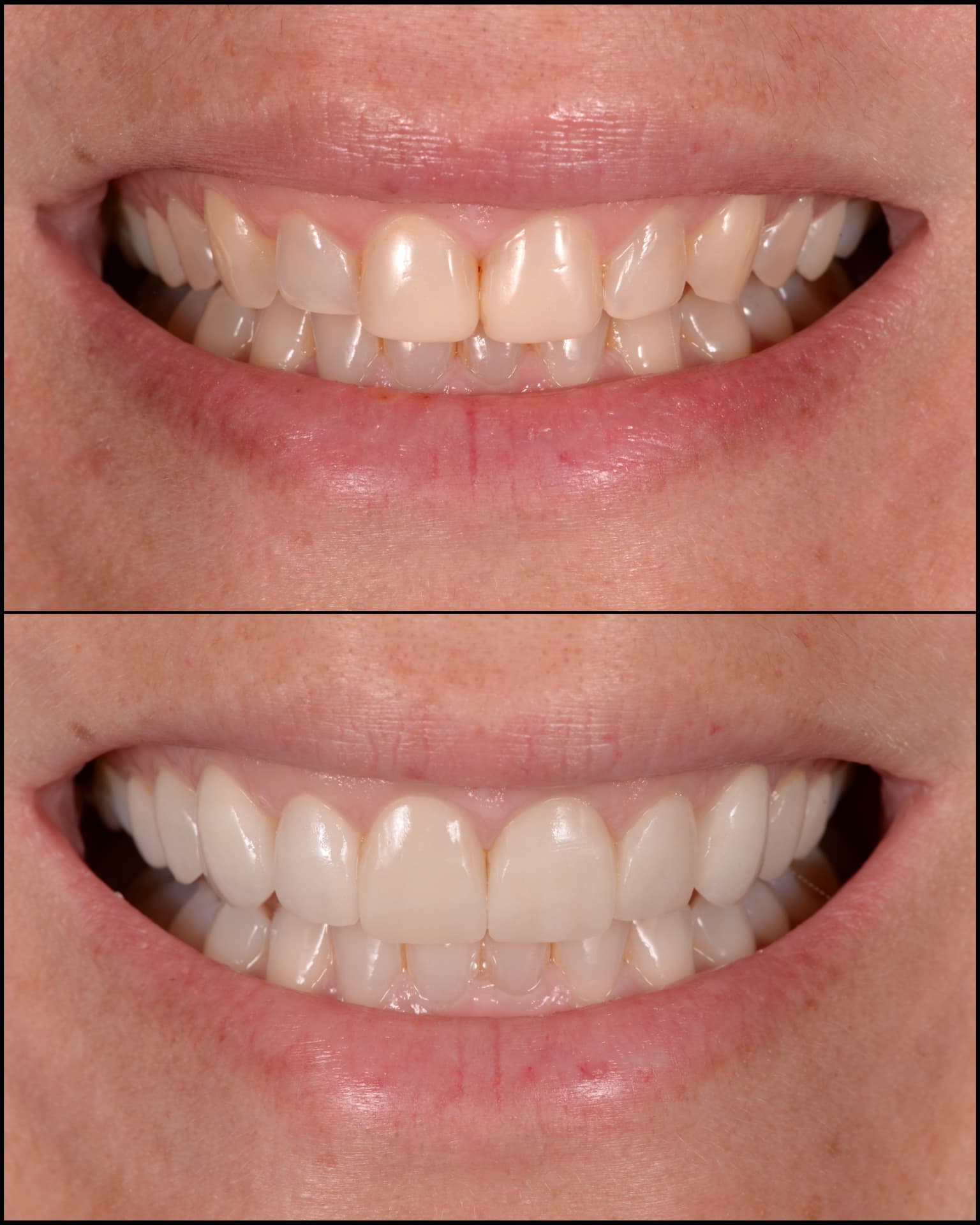Antes y después de una transformación de sonrisa