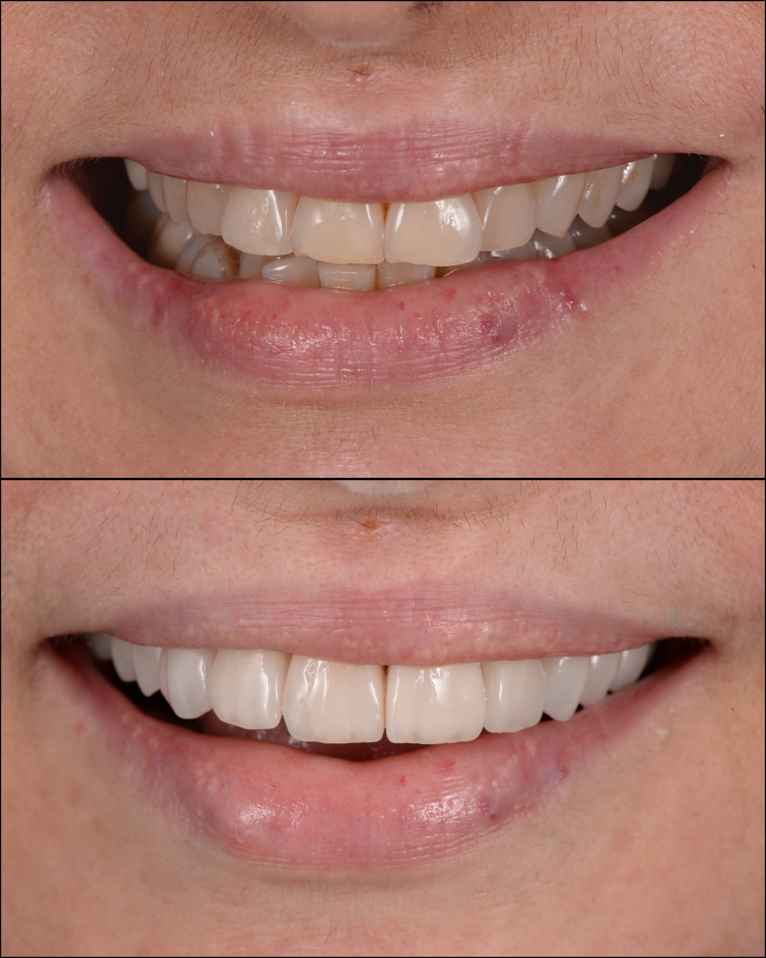 Antes y después de una transformación de sonrisa