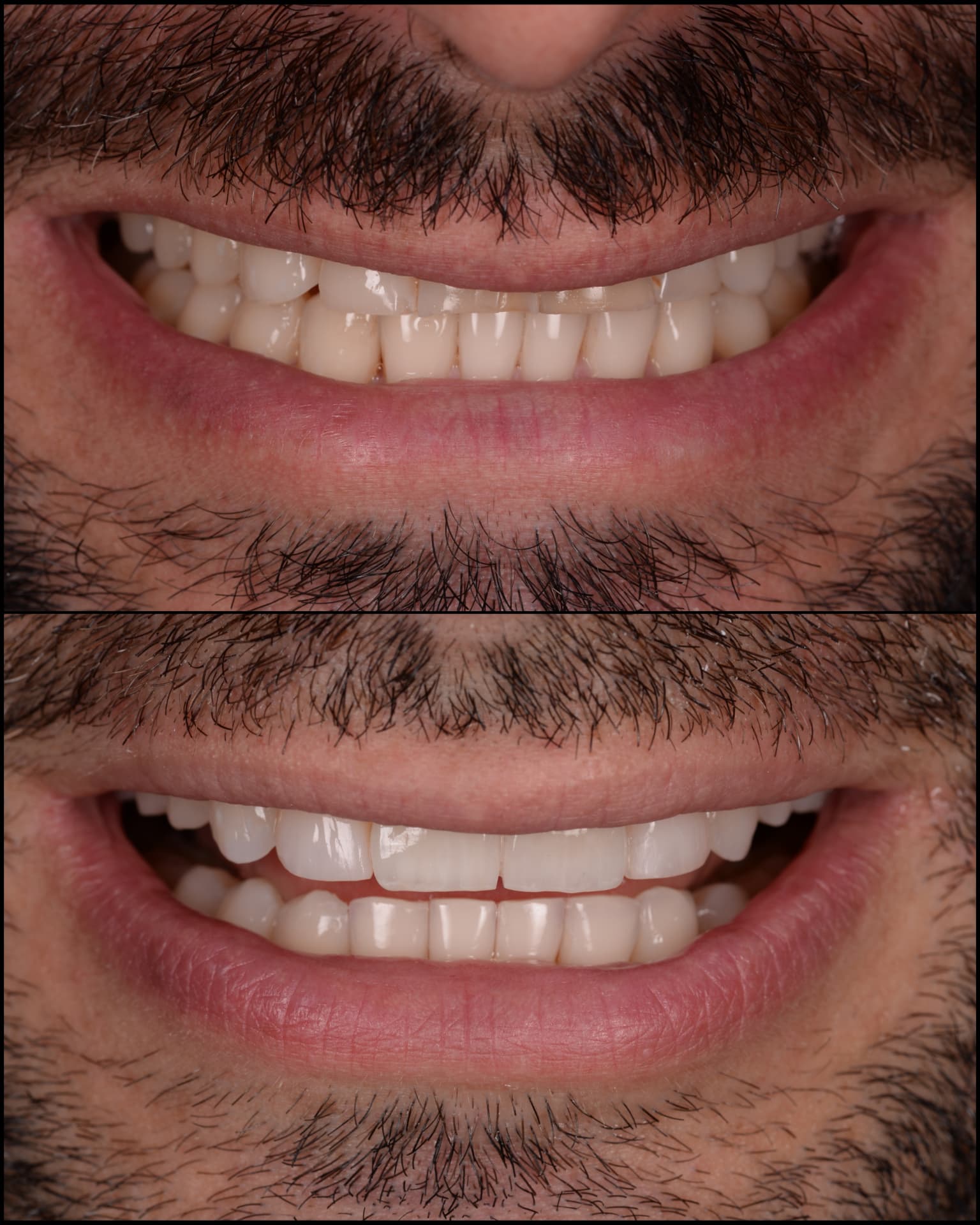 Antes y después de una transformación de sonrisa