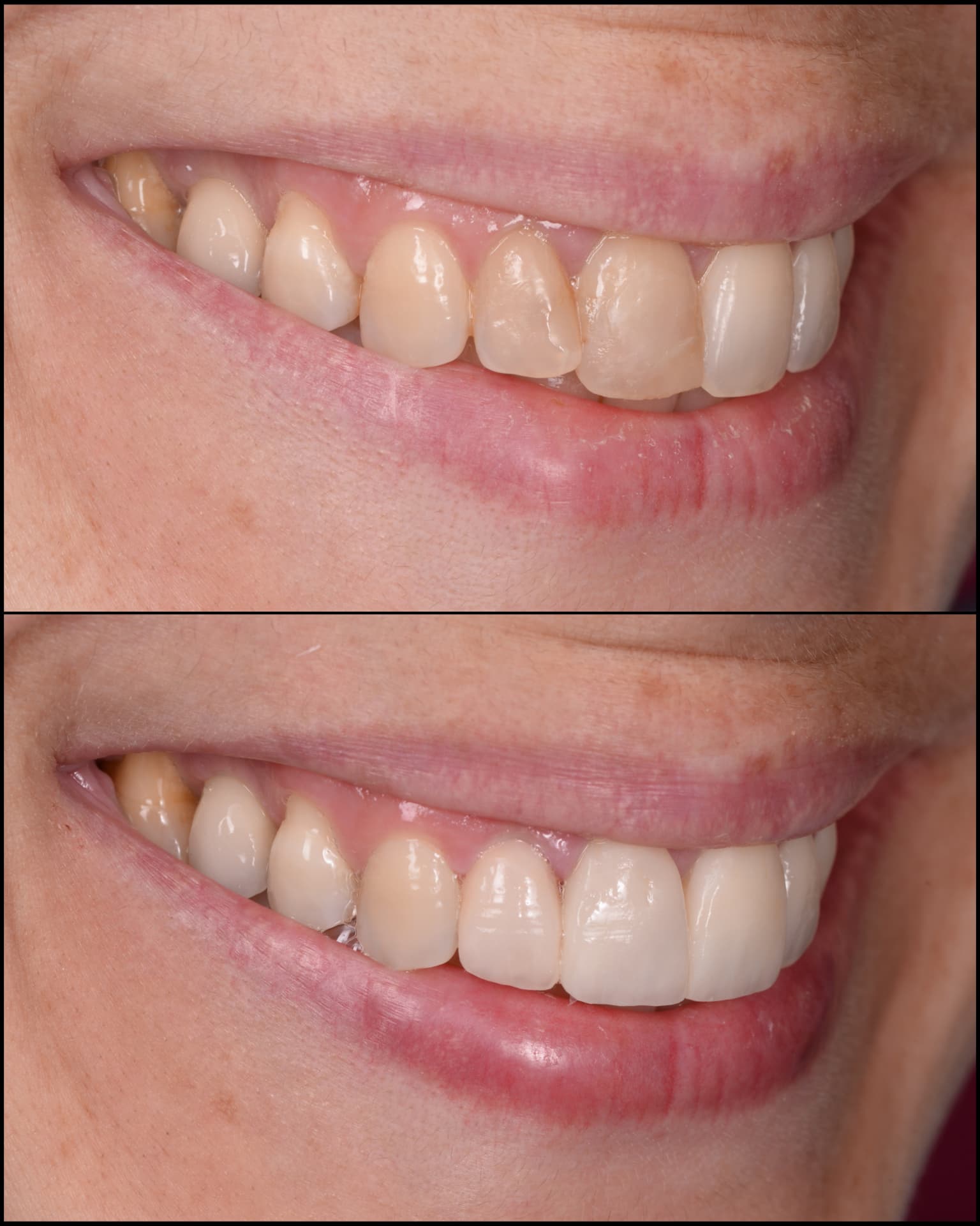 Antes y después de una transformación de sonrisa